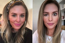Influencer αποκαλύπτει τι συμβαίνει όταν ένα Botox πάει λάθος: «Είναι τόσο ντροπιαστικό»