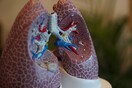 Καρκίνος του πνεύμονα: Ο προσυμπτωματικός έλεγχος βελτιώνει τη μακροπρόθεσμη επιβίωση των ασθενών