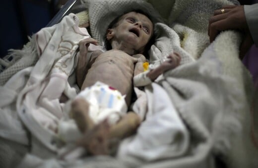 Σοκαριστικές εικόνες μωρού που πεθαίνει από την πείνα στη Συρία αποκαλύπτουν τη φρίκη του πολέμου