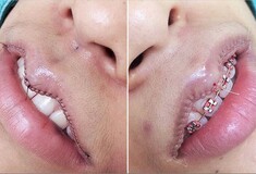 Μικρά, πολύ μικρά χείλη: η νέα απωθητική τάση στην πλαστική χειρουργική