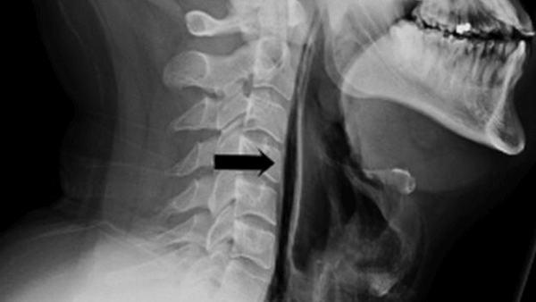 Οι γιατροί προειδοποιούν: Σκίστηκε ο λαιμός άντρα που προσπάθησε να συγκρατήσει το φτάρνισμά του