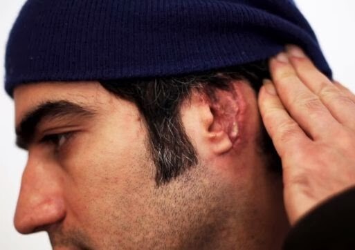 Συνέλαβαν τον μετανάστη που άγνωστοι του έκοψαν το αυτί