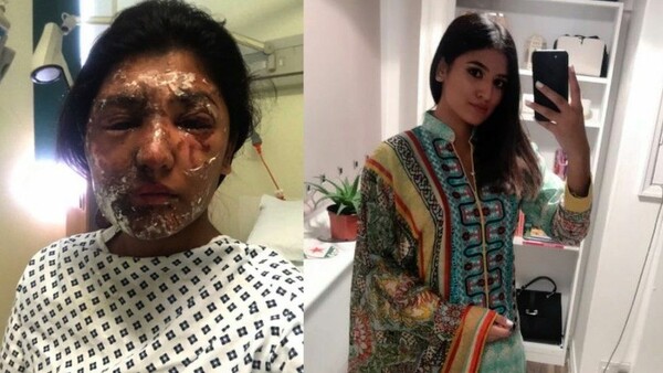 Μία κοπέλα, θύμα επίθεσης με οξύ, μοιράζεται τις φωτογραφίες της ανάρρωσής της