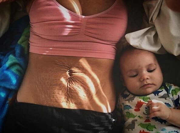 Η ωμή πραγματικότητα μετά την εγκυμοσύνη: Μητέρες δείχνουν περήφανες τα σημάδια στο σώμα τους