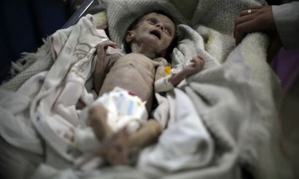 Σοκαριστικές εικόνες μωρού που πεθαίνει από την πείνα στη Συρία αποκαλύπτουν τη φρίκη του πολέμου
