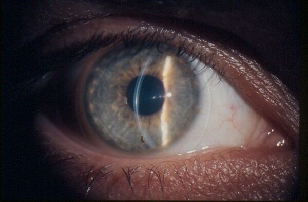 Βρετανία: Χειρουργοί αφαίρεσαν 27 φακούς επαφής από το μάτι γυναίκας