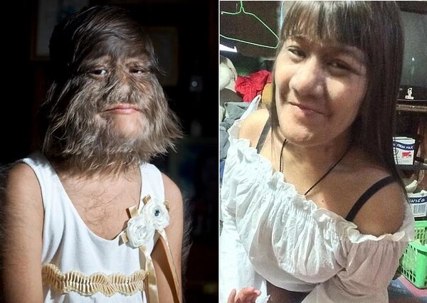 Το «πιο τριχωτό κορίτσι του κόσμου» παντρεύτηκε και αποφάσισε πλέον να ξυρίζει το πρόσωπό της